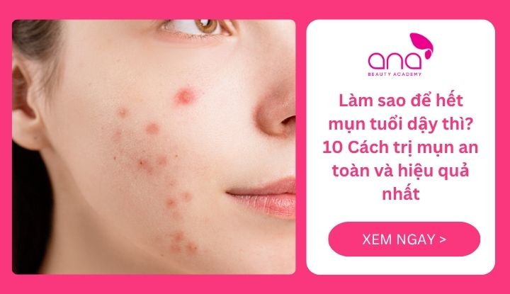 Làm sao để hết mụn tuổi dậy thì